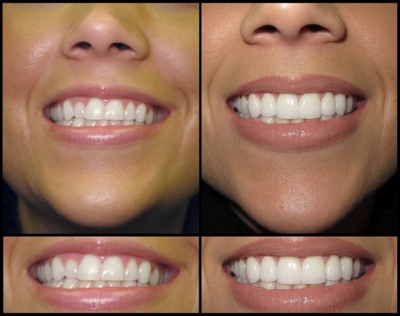 Smile Makeover